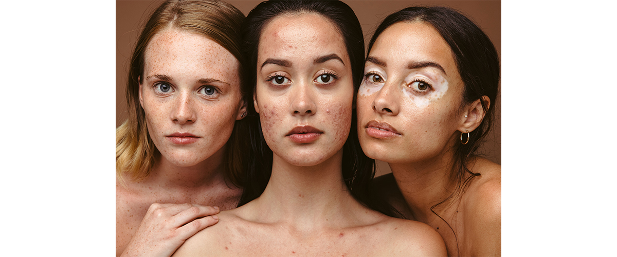 Post-Summer Holistic Treatments for Hyperpigmentation Post-Summer Holistic Treatments for Hyperpigmentation