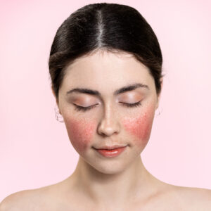 Out of the Red – Addressing Rosacea