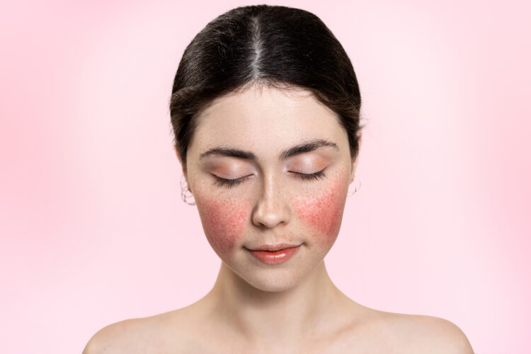 Out of the Red – Addressing Rosacea