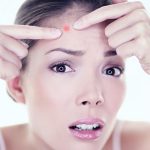 Acne: 4 Lifestyle Changes for Acne Solutions