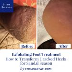 How to Transform Cracked Heels for Sandal Season | Exfoliating Foot Treatment