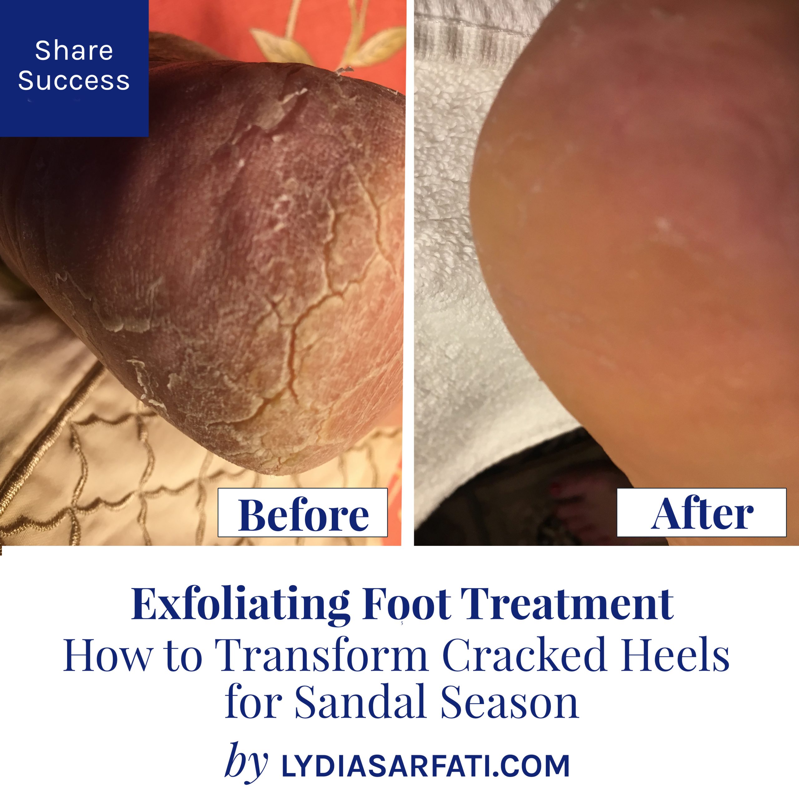 Foot Crack Treatment,Corn Removal Surgery in Surat