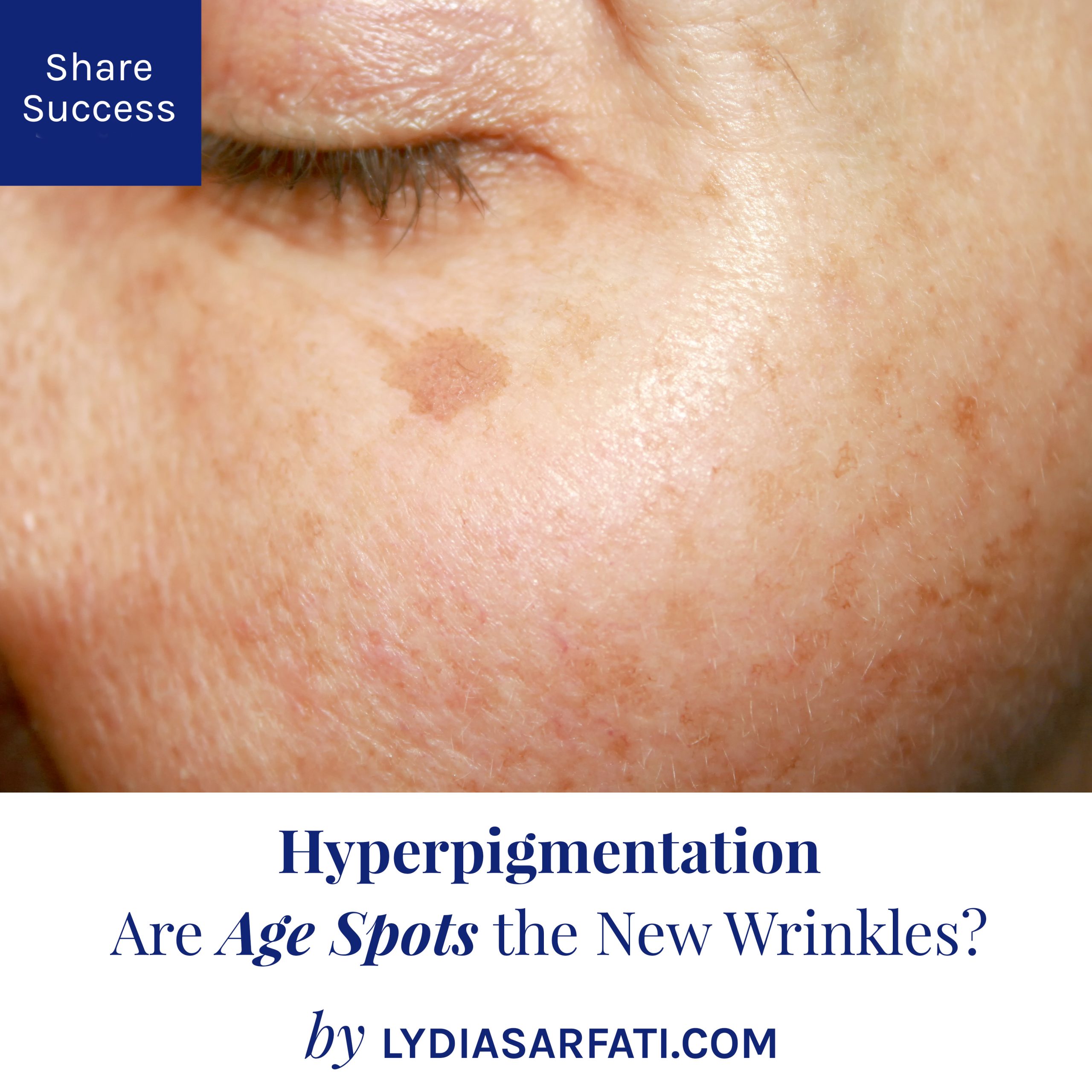 Age Spots: Causes and Treatment