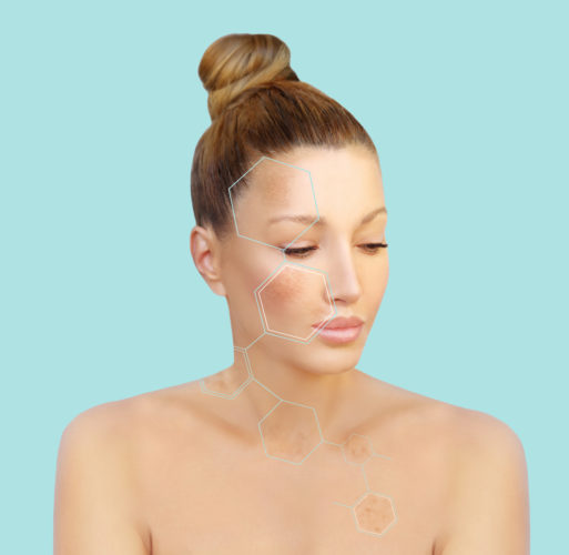 Differentiating between Melasma and Post Inflammatory Hyperpigmentation (PIH)