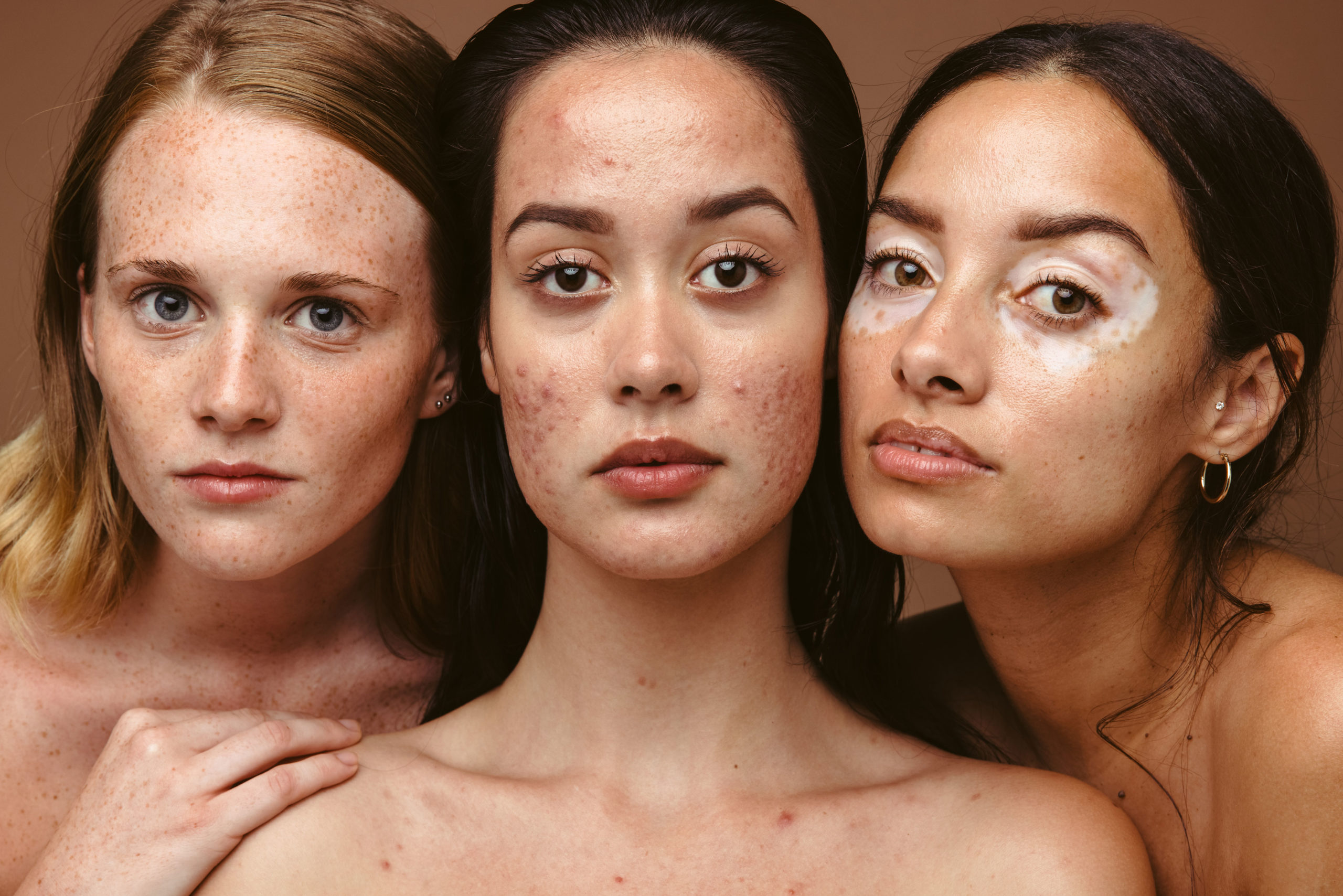 Post-Summer Holistic Treatments for Hyperpigmentation