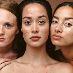 Post-Summer Holistic Treatments for Hyperpigmentation