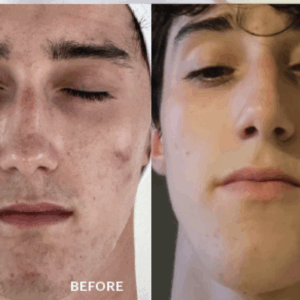 How to Transform Your Business and Your Client’s Skin with Treatments for Oily, Problem Skin