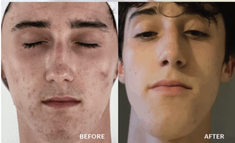 How to Transform Your Business and Your Client’s Skin with Treatments for Oily, Problem Skin