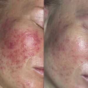 Soothe Sensitive Skin: The Complete Esthetician’s Guide to Rosacea Care and Client Retention
