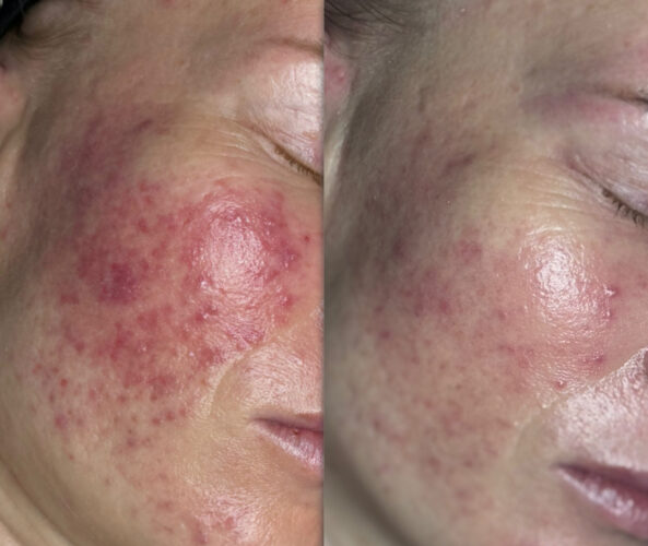 Soothe Sensitive Skin: The Complete Esthetician’s Guide to Rosacea Care and Client Retention