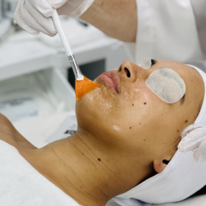 All About Peels: What Estheticians Need to Know