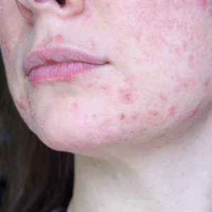 Professional Approach to Treating Problem, Acne Skin According to an Esthetician