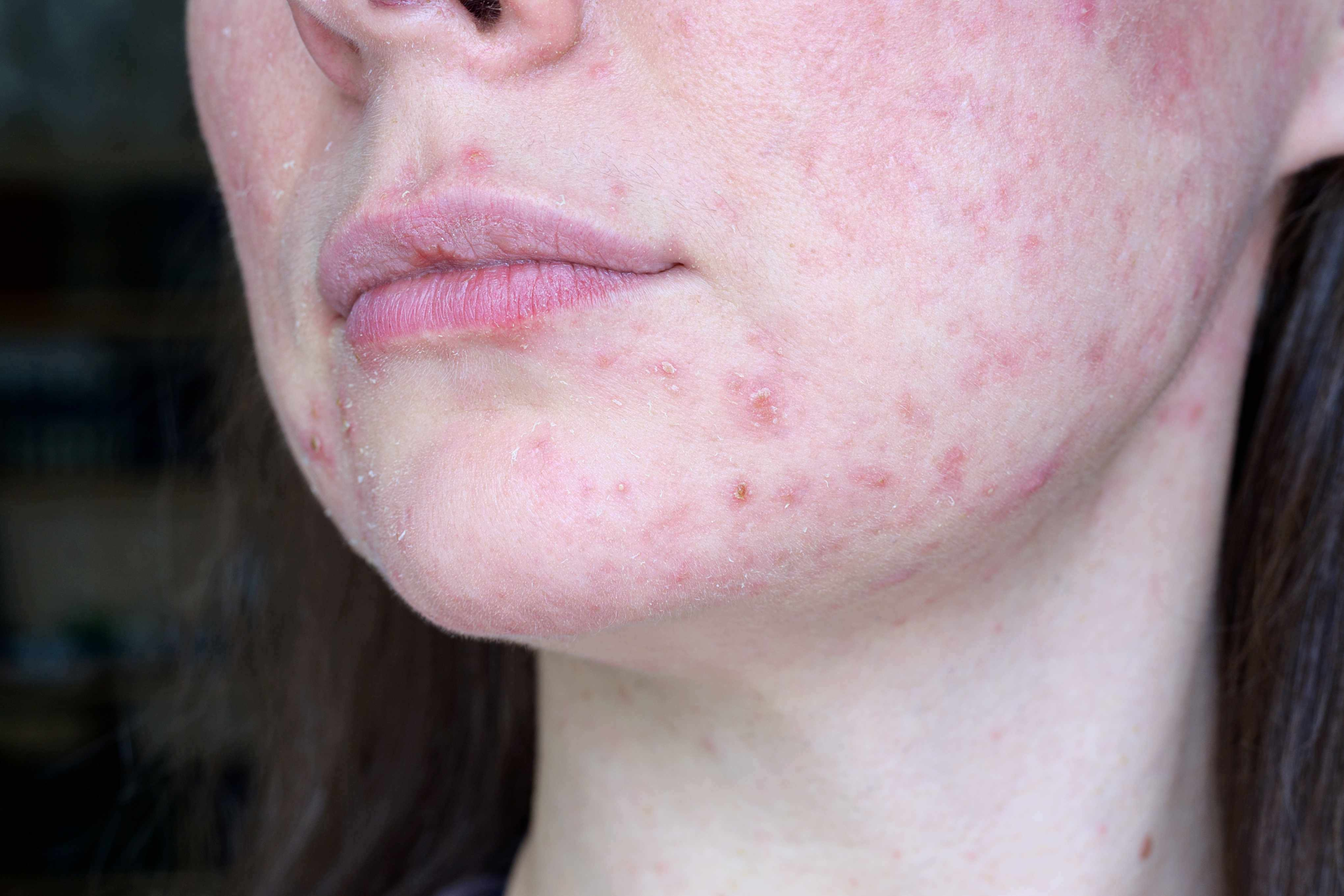 Professional Approach to Treating Problem, Acne Skin According to an Esthetician